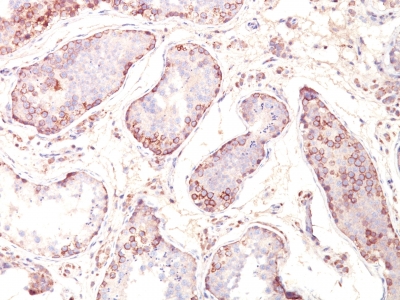 FFPE human testicular carcinoma sections stained with 100 ul anti-MAGE-1 (clone MZ2E/838) at 1:50. HIER epitope retrieval prior to staining was performed in 10mM Citrate, pH 6.0.